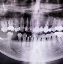 Root Canal Treatment
