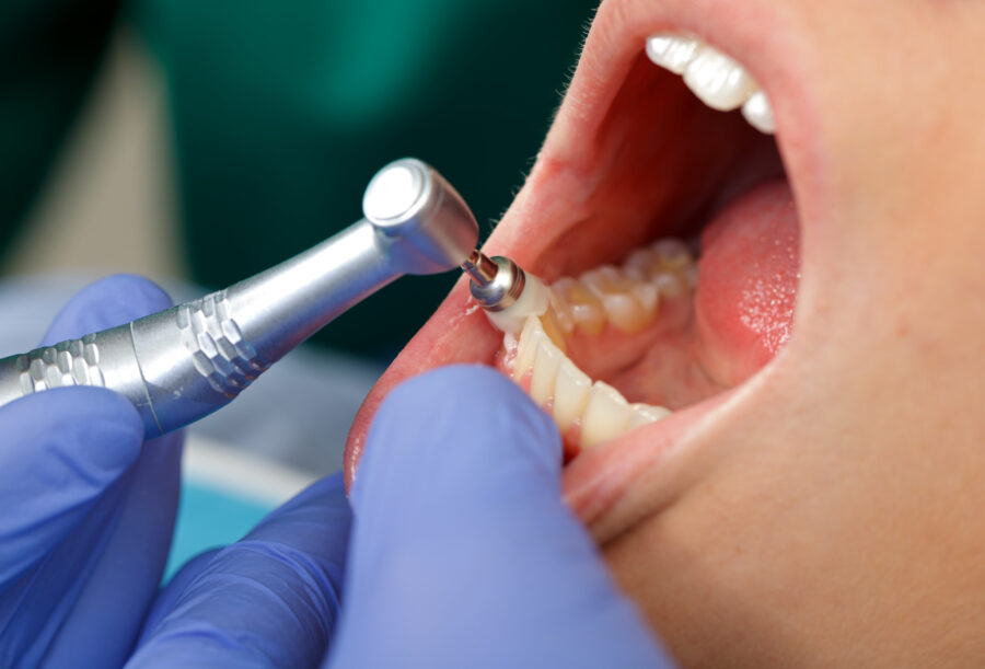 What does dental hygiene treatment involve? image