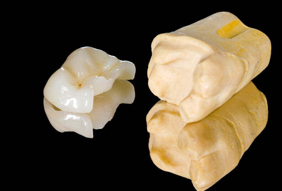 Why have an inlay or onlay? image