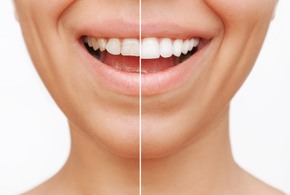The benefits of choosing veneers in Nottingham